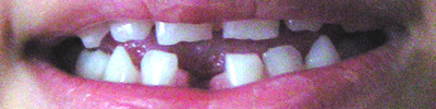 no tooth, just a gap